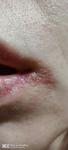 Герпес или другое заболевание кожи вокруг нижней губы фото 3