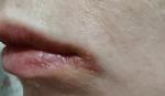 Герпес или другое заболевание кожи вокруг нижней губы фото 4