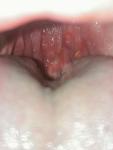 Странные волдыри в горле и белые пузырьки на миндалинах фото 2