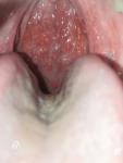 Странные волдыри в горле и белые пузырьки на миндалинах фото 1