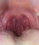 Странные волдыри в горле и белые пузырьки на миндалинах фото 3