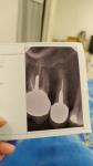 В чем причина появления кисты после протезирования зуба? фото 1