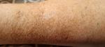 Пигментные коричневые пятна на ногах до колена с язвенными ямочками фото 1