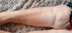 Пигментные коричневые пятна на ногах до колена с язвенными ямочками фото 5