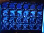 Головные боли, расшифровка МРТ головного мозга фото 2