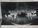 Описание снимка, сверхкомплектный зуб фото 1
