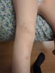 Мелкие синяки на ногах у ребенка фото 2