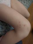 Мелкие синяки на ногах у ребенка фото 1