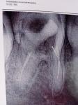 Воспаление корня зуба, перелечивание фото 2