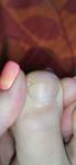 Полоска и пятно на ногте большого пальца фото 3