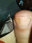 Полоска и пятно на ногте большого пальца фото 2
