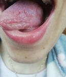 Почему болит язык? фото 1