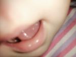 Белые пузырьки у грудничка во рту фото 2