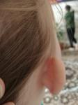 Горошевидное уплотнение за ухом маленького ребенка фото 3