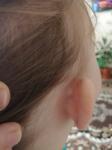 Горошевидное уплотнение за ухом маленького ребенка фото 2