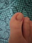 Темное пятнышко на ногте ноги фото 2