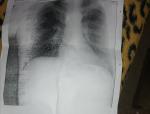 Левосторонняя пневмония, температура фото 2