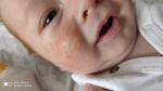 Покраснения на щеках у двухмесячного ребенка фото 1