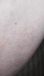 Мелкая красная сыпь на коже шеи и рук фото 1