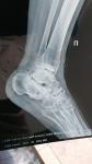 Боль в ноге после перелома лодыжки фото 2