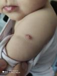 Прививка БЦЖ у ребенка сильно выступает фото 3