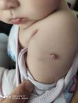 Прививка БЦЖ у ребенка сильно выступает фото 1