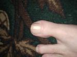 Грибок ногтя или что то другое, как вылечить? фото 3