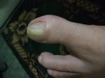 Грибок ногтя или что то другое, как вылечить? фото 1