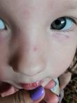 Красные разветвения возле глаза у ребёнка фото 2