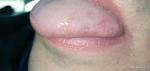 Болит язык слева и белое пятно фото 2