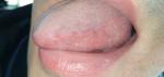 Болит язык слева и белое пятно фото 1