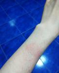 Трещины на пальцах, солнечная аллергия фото 2
