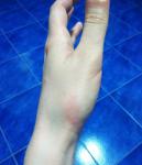 Трещины на пальцах, солнечная аллергия фото 1