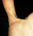Трещины на пальцах, солнечная аллергия фото 3