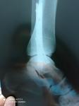 Остеосинтез лодыжек, сильный отек, рентген фото 2