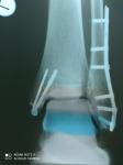 Остеосинтез лодыжек, сильный отек, рентген фото 1