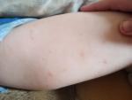 Синяки на ногах у ребёнка 4 года фото 2