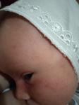 Аллергия У ребенка на лице фото 1