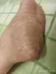 Трещины на пятке и сильная сухость кожи ступни одной ноги фото 1
