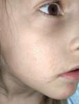 У ребенка 6 лет не проходит раздражение на лице фото 2