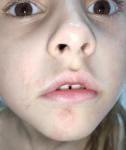 У ребенка 6 лет не проходит раздражение на лице фото 1