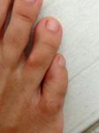 Опух палец на ноге фото 2