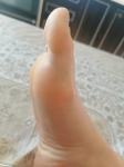 Ушиб большого пальца ноги фото 3