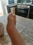 Ушиб большого пальца ноги фото 2