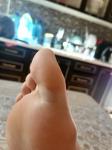 Ушиб большого пальца ноги фото 1