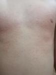 Красная сыпь на груди и спине у ребенка фото 1