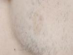 Пигментное пятно на лице. Родимое или Мелазма? фото 2