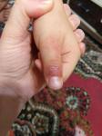 Воспалился палец после ссадины у ребенка 4 лет фото 1