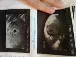 Миома и беременность 4 недели риски фото 2