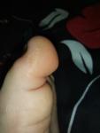 Корочка на пальце ноги у ребёнка фото 1